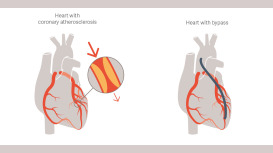 CABG Surgery Cost in India for Ethiopian Patients